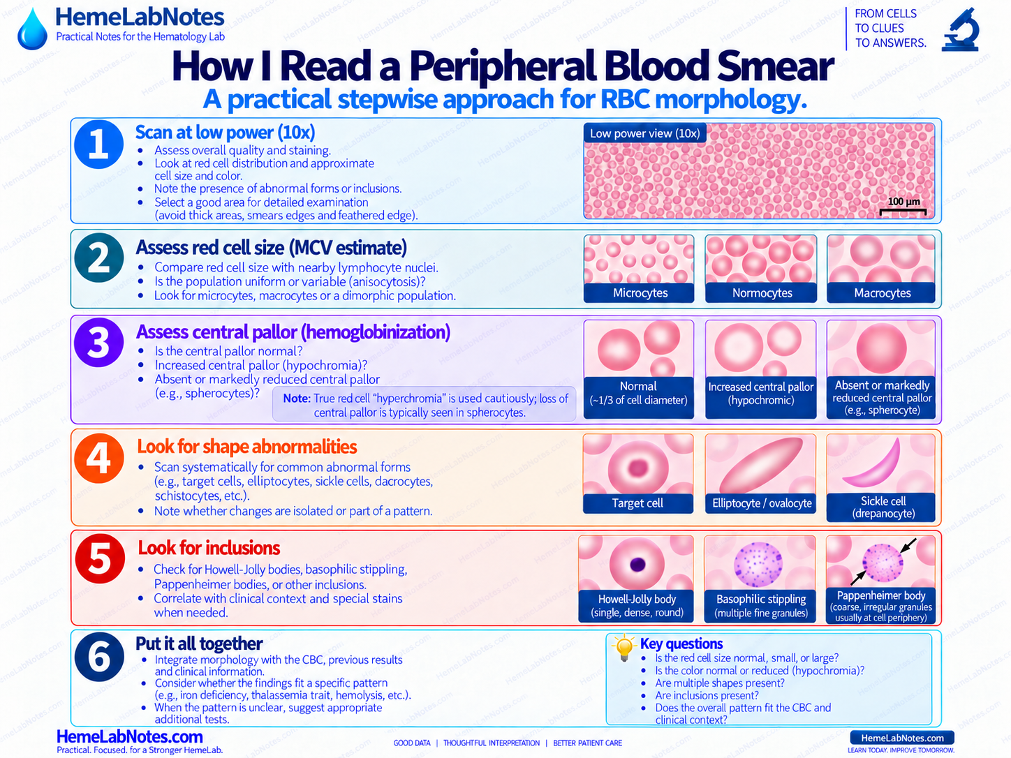 Practical stepwise approach to peripheral blood smear interpretation, including low-power review, cell size, central pallor, shape abnormalities, inclusions, and correlation with the CBC.